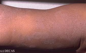 Eczema (Atopic Dermatitis) Causes, Symptoms, Treatment